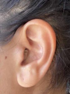 Signia Silk Hearing Aid In Ear.