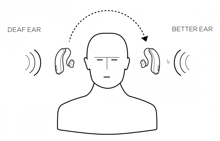 Widex BiCROS hearing aid system