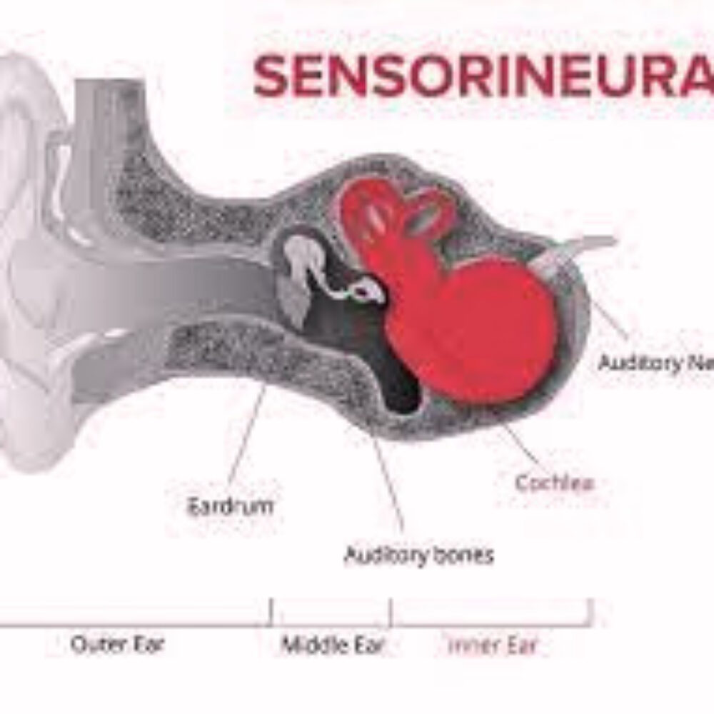 Sensorineural Hearing Loss: Evaluation, Management, and Interprofessional Approach