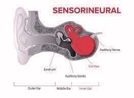 Read more about the article Sensorineural Hearing Loss: Evaluation, Management, and Interprofessional Approach