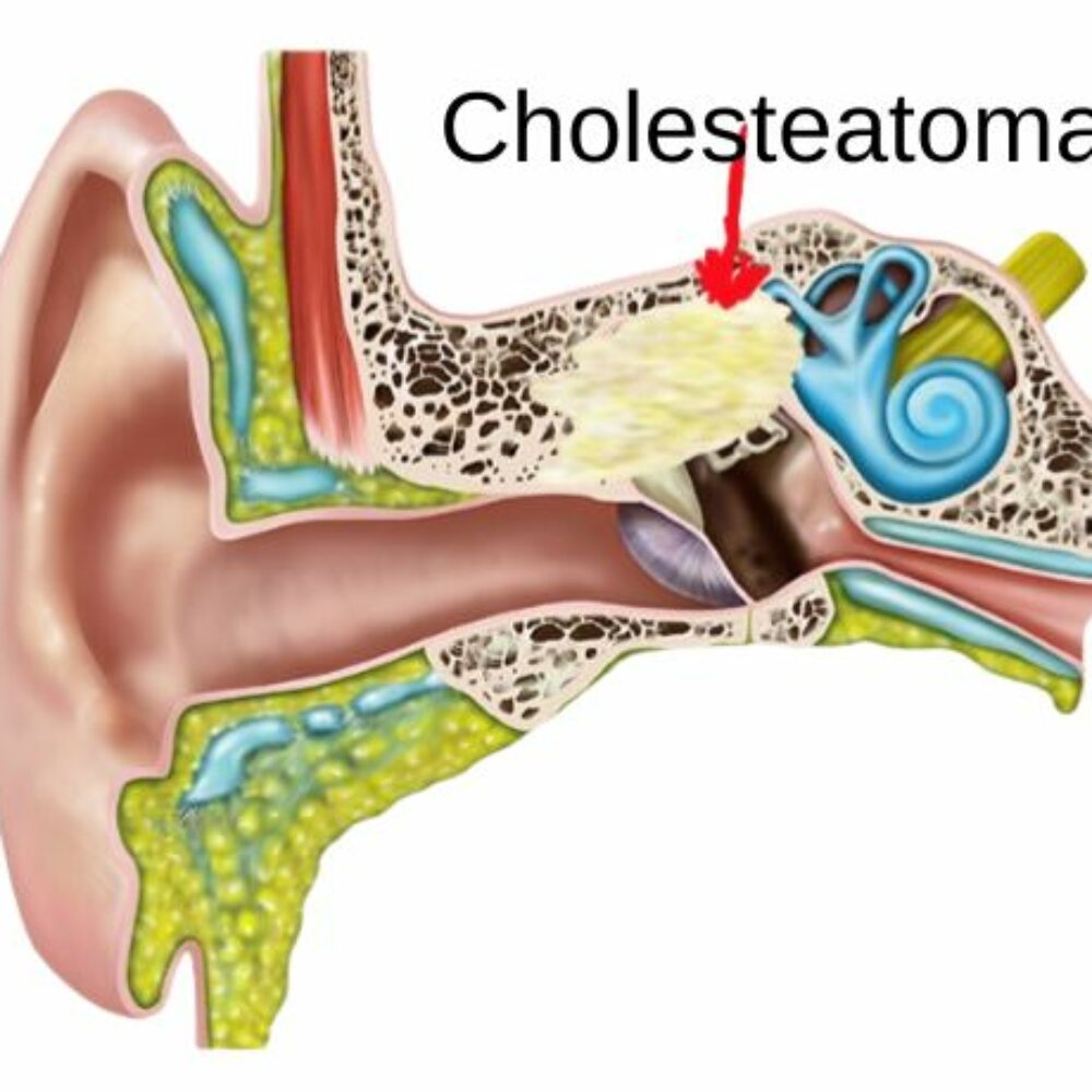 Chronic Inflammation of the Middle Ear: Understanding Cholesteatoma and Its Impact on Hearing and Balance