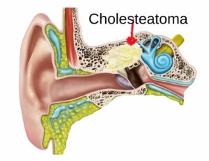 Read more about the article Chronic Inflammation of the Middle Ear: Understanding Cholesteatoma and Its Impact on Hearing and Balance