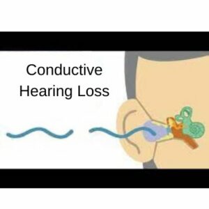 Read more about the article Rewriting the Landscape of Conductive Hearing Loss